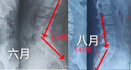 腰骶成角与胸廓矫正对比