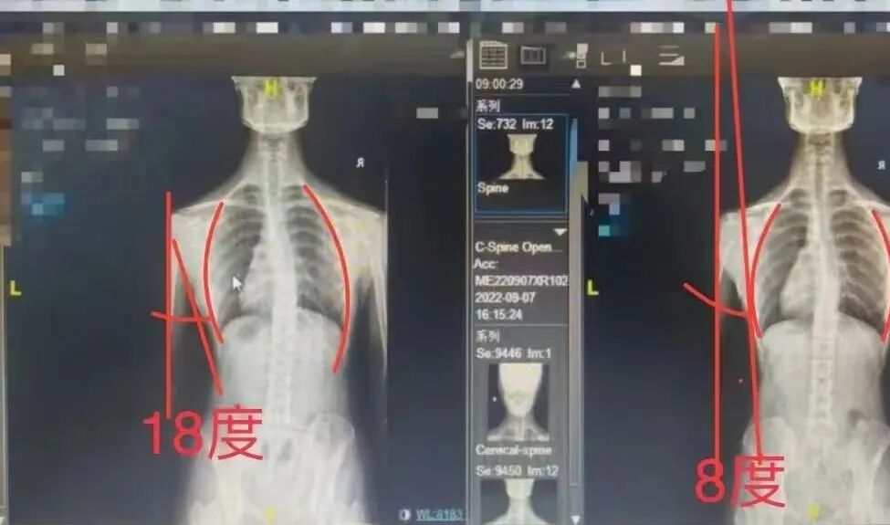 静脉曲张针灸治疗前后对比