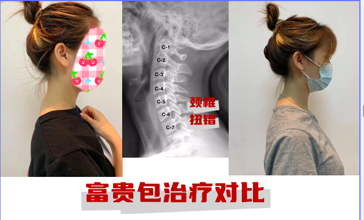 治疗前后对比2